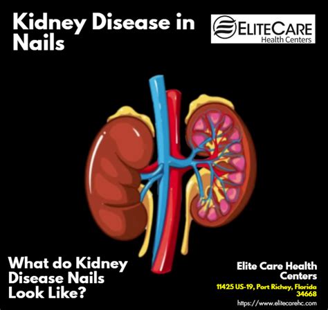 Kidney Disease in Nails | Elite Care Health Centers - Elite Care Health ...