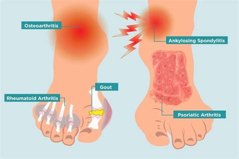 Arthritis in Your Feet: Causes, Symptoms, and Treatment