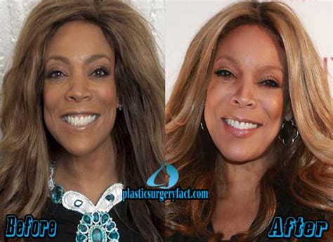 Wendy Williams Plastic Surgery Before and After