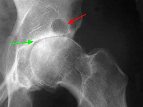 Xray of normal hip joint vs osteoarthritic - stationlity
