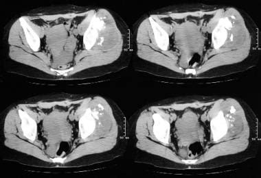 Imaging in Osteochondroma and Osteochondromatosis: Overview, Radiography, Computed Tomography