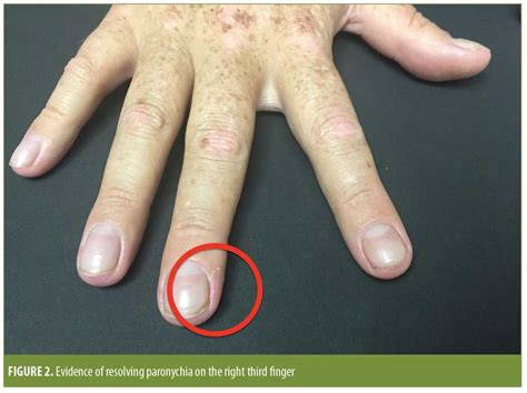 Acute And Chronic Paronychia Causes, Prevention Paronychia