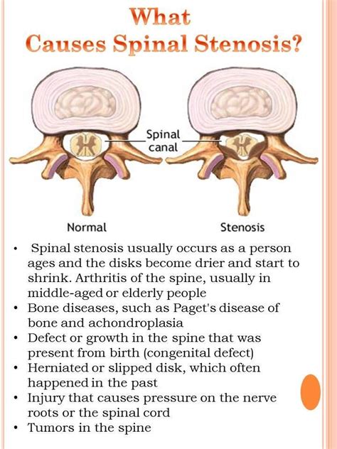 What Causes Spinal Stenosis? | Spinal stenosis, Lumbar spinal stenosis, Cervical spinal stenosis