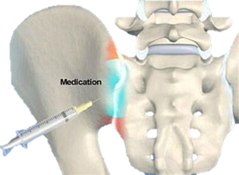 Sacroiliac Joint Pain - Rehab On The Road