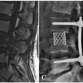 A patient with L4 burst fracture underwent posterior instrumentation ...