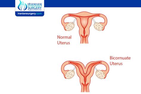 Bicornuate Uterus | Iranian Surgery