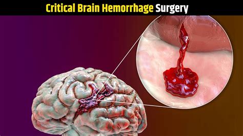 Critical Brain Hemorrhage Surgery Brain Hemorrhage Operation - Mad Gaming - YouTube