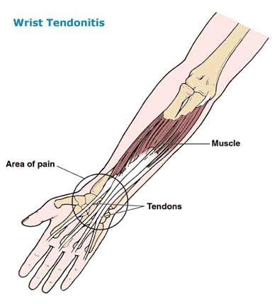 Picture Of Forearm Tendons : How To Get Rid Of Forearm Tendonitis With ...