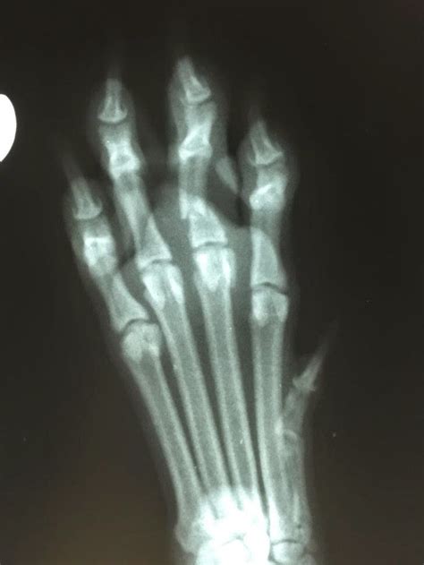 How Sam Sees It: Broken Toe Update