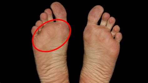 What is that pain in the ball of my feet? - Triumph Institute