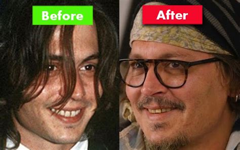 Johnny Depp Teeth Fix! Before & After Comparison in 2022 | Johnny depp ...