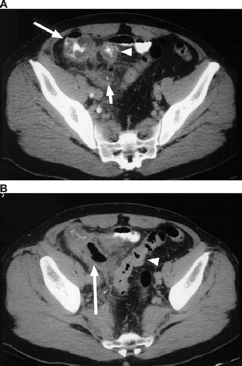 CT scan of a 56-year-old man with ruptured appendicitis shows (A) an ...