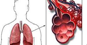 Allergic Bronchopulmonary Aspergillosis (ABPA)- Symptoms, Causes And ...