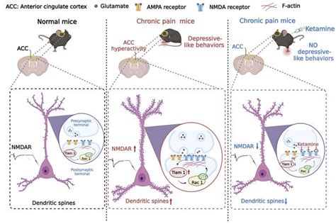 JCI - TIAM1-mediated synaptic plasticity underlies comorbid depression–like and ketamine ...