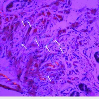 Congo red stain showing the amorphous material is congophilic and... | Download Scientific Diagram