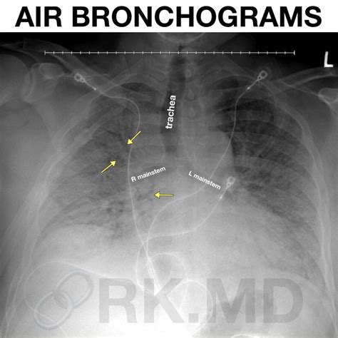 Air Bronchograms | RK.MD