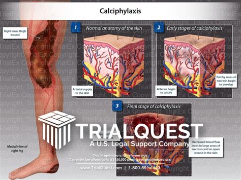 Calciphylaxis - TrialQuest Inc.