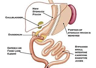 Coastal Center for Obesity : Weight Loss Surgery : Duodenal Switch Procedure