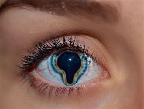 coloboma - Any defect in the iris that allows light to enter the eye, other than through the ...