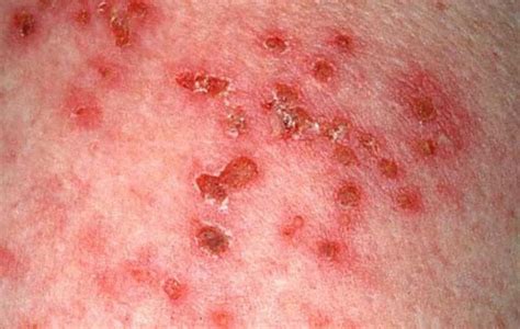 What Does Shingles Look Like? | FindATopDoc