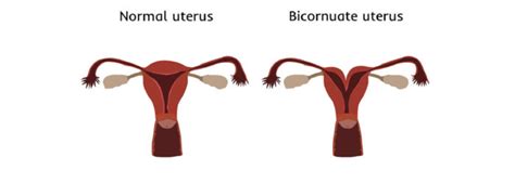 Heart shaped uterus: symptoms, causes, consequences on fertility