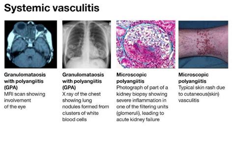 Vasculitis | Institute of Immunity and Transplantation - UCL ...