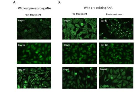 Indirect immunofluorescence images that show differences in ANA ...