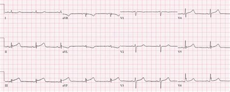 Subtle Inferior MI | ECG cases | EM cases