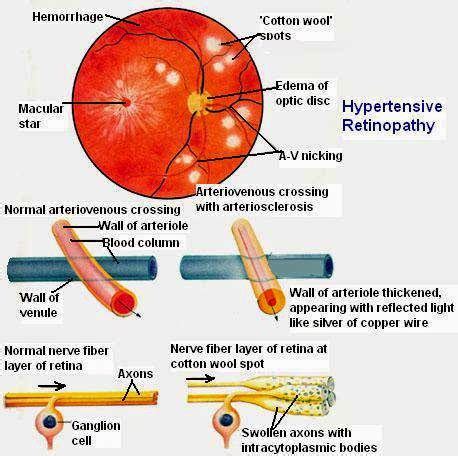 Read It: Retinopati Hipertensi