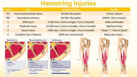 Hamstring Injuries — Rebound Rehabilitation