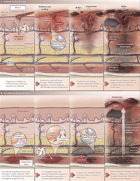 Mauricio Ambriz on Twitter: "Evolución de la fascitis necrosante o mionecrosis: NEJM 2017; DOI ...