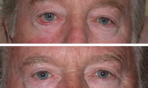 Ectropion | Eyelid Surgery Centre | Eyelid & Midface Specialist Surgeon ...