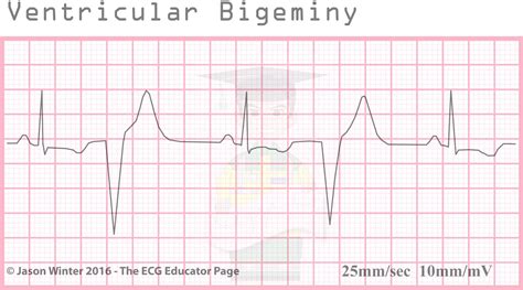 ECG Educator Blog : Ventricular Ectopics