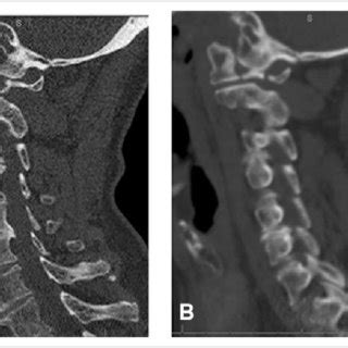 (PDF) Outcomes of Halo Immobilization for Cervical Spine Fractures