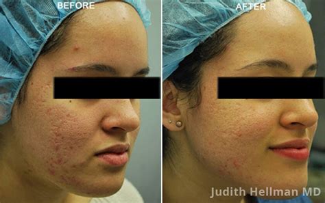 LARGE PORES BEFORE & AFTER PHOTOS | NYC TREATMENT