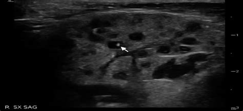 Parotitis on Ultrasound: The Pomegranate Sign : Pediatric Emergency Care