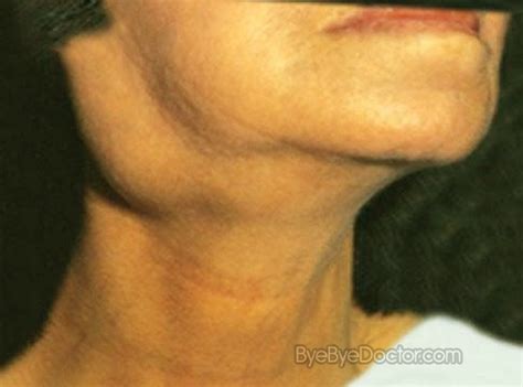 Swollen Glands in Neck – Causes and Treatment - Minhhai2d Help Doctor