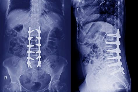 Stages of Degenerative Disc Disease