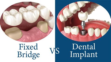 Difference between dental bridge and dental implants. | Dental implants ...