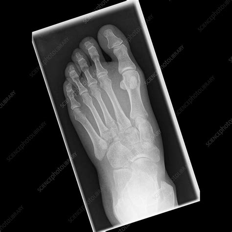 Xray Broken Foot