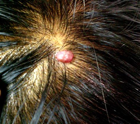 Head Lesions On Scalp