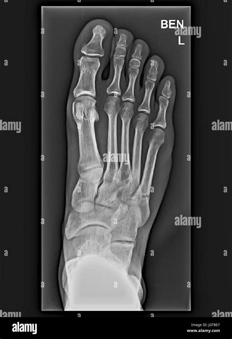 Foot Medical Xray, broken bone, Patient treatment Stock Photo - Alamy