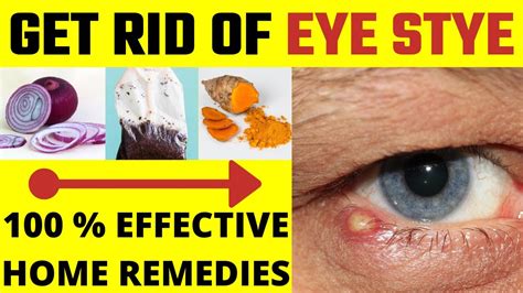 Home Remedies for Styes in the Eye | How to Treat a Stye | Eye Stye Treatment - YouTube