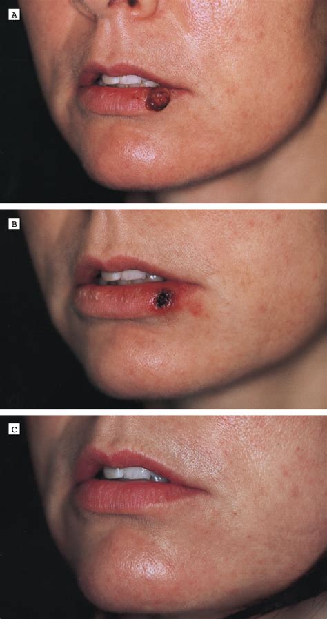 The Combined Continuous-Wave/Pulsed Carbon Dioxide Laser for Treatment of Pyogenic Granuloma ...