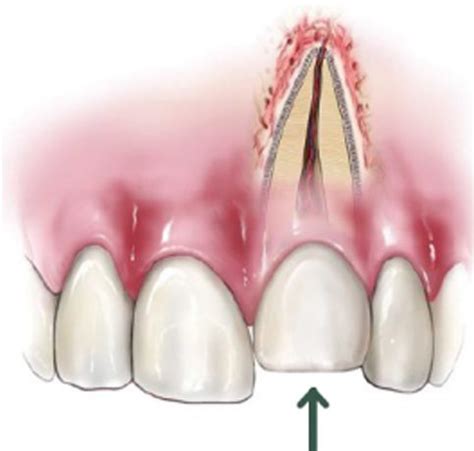 Dental Fracture Treatment in Patna | Best Dentist in Patna | Dr. Aishwarya