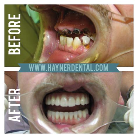 Preventing Tooth Decay (Cavities!) - Hayner Dental