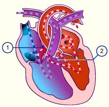 Cardiac Defects with a Left to Right Shunt (Acyanotic) | Cardiac Health