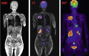 difference between mri and pet ct Archives - PetScan