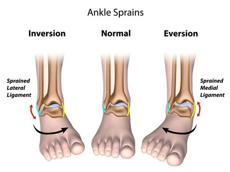 Ankle Sprain Image - Back in Action