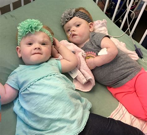 5 Months After Life Changing Surgery, Former Conjoined Twins Are Finally On Their Way Home